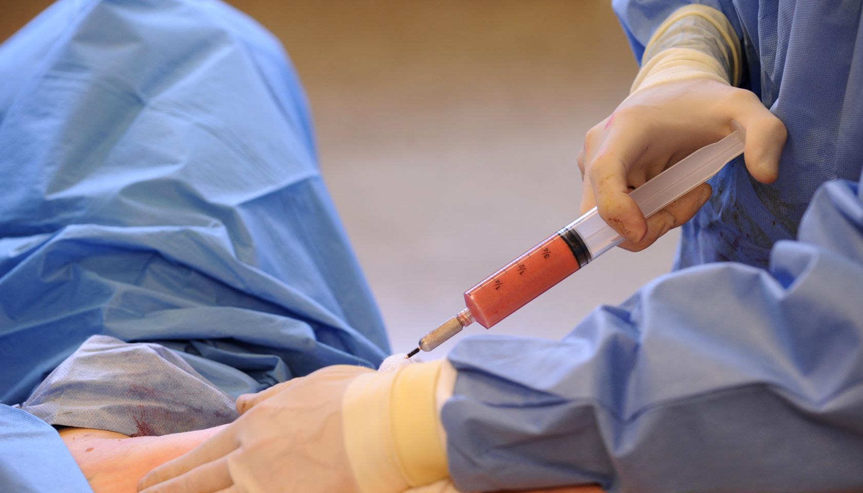 Triple board certified plastic surgeon Dr. David Broadway injects the fat from the back and buttocks back into the breasts of patient Sherri Frie. About 400 cubic centimeters of fat was re-injected into each breast. Each of these syringes holds about