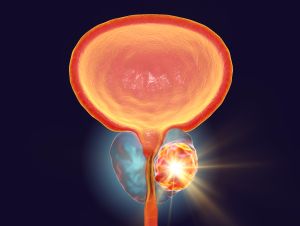 Treatment of prostate cancer, conceptual illustration